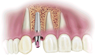 Имплантация зубов – виды имплантатов