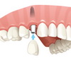 установка импланта при потере бокового зуба