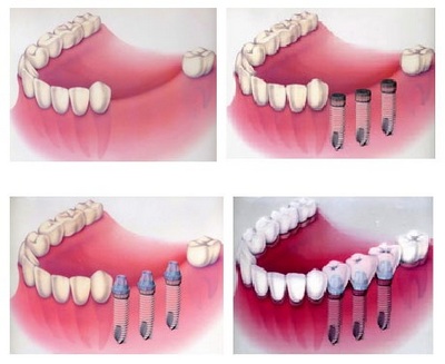 Установка имплантанта зуба — цена | Установка имплантов после удаления зуба в «Ланри Клиник»