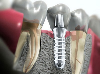 импланты зубные цена