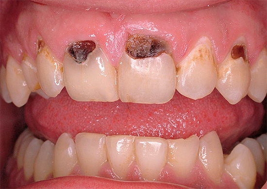 Профилактика передних зубов