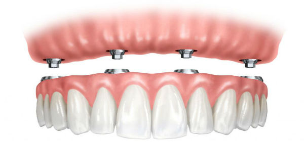 импланты зубов