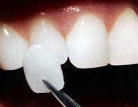 микропротезирование винирами и люминирами, установка виниров, протезирование зубов