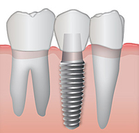 имплант, искусственный имплатант, восстановление зубов