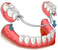 балочное крепление импалнтов, имплантация зубов, искусственые зубы, протезы