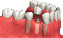 установка протеза зуба