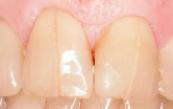Трещина зуба