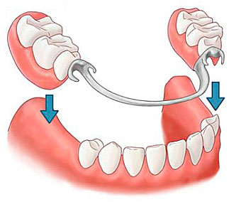 bugelnoe2